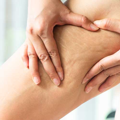 Anticellulitesmagliature--